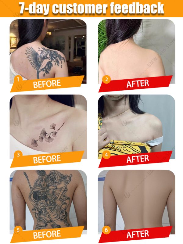 old permanent tattoo removal - Image 4