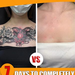 old permanent tattoo removal